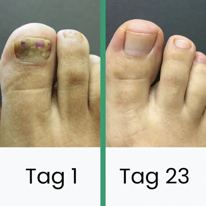 Schulz LLLT nail fungus therapy