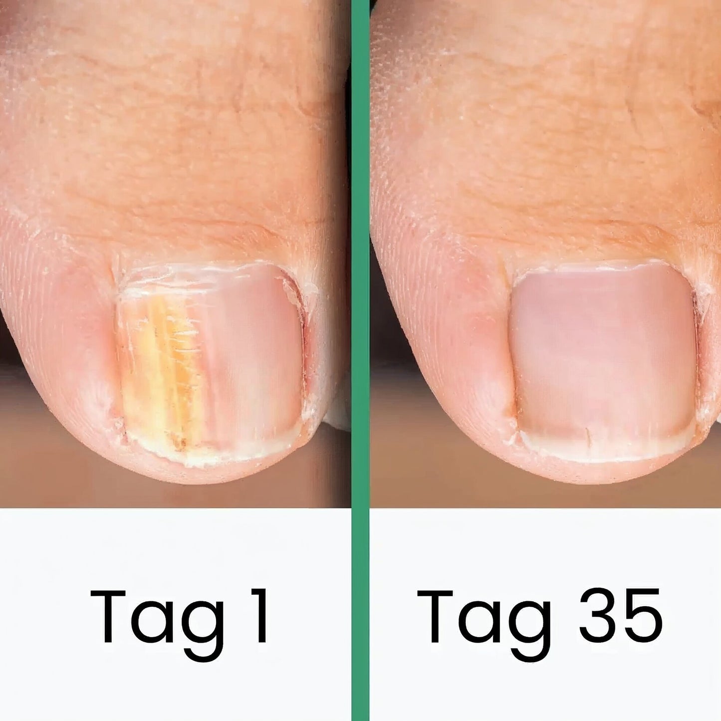 Schulz LLLT nail fungus therapy